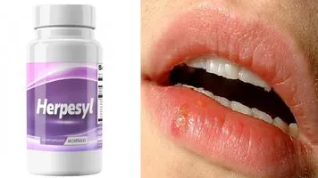 Herpesyl Review: Pricing, Side Effects Pros And Cons
