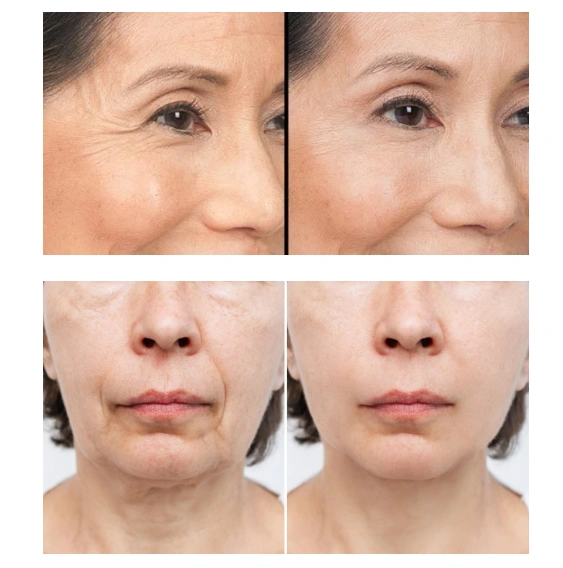 Olavita Botox Serum Before and After 